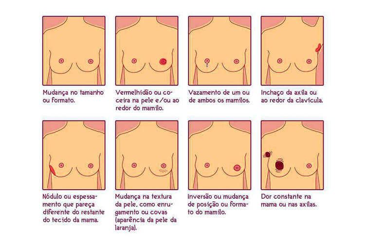 sintomas do câncer de mama