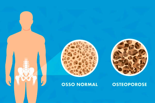 diagnóstico da evolução da osteoporose