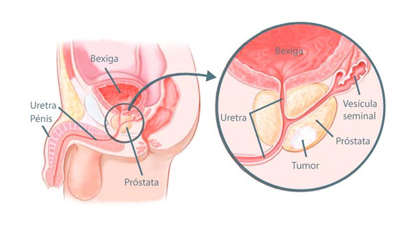 Cele mai bune tratamente naturale pentru prostata marita – ce este prostata, hipertrofia prostatică