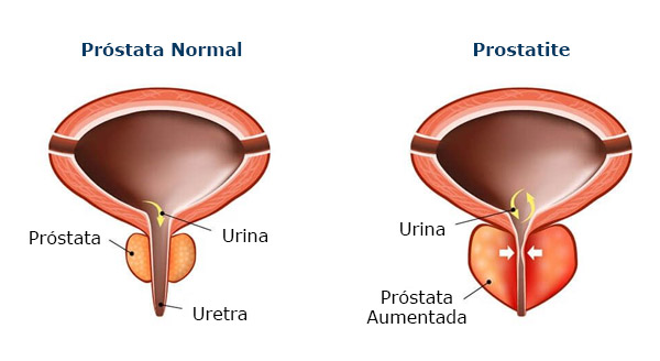 prostatitis crónica abacteriana)
