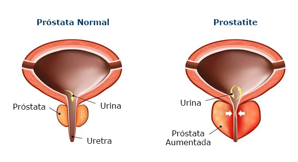 prostatite