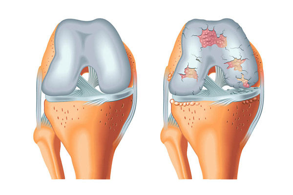 artrose no joelho