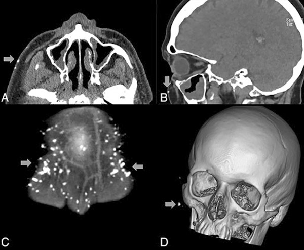 tomografia do crânio com contraste