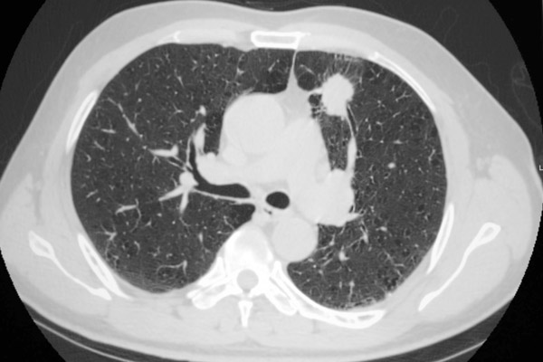 imagem de uma tomografia do tórax realizada em BH