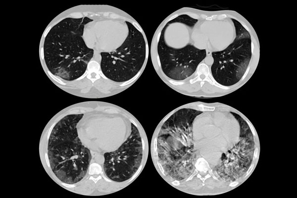 tomografia do pulmão em caso de Covid